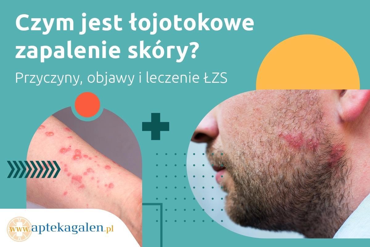 leczniczy szampon na zmiany łojotokowe zapalenie skóry