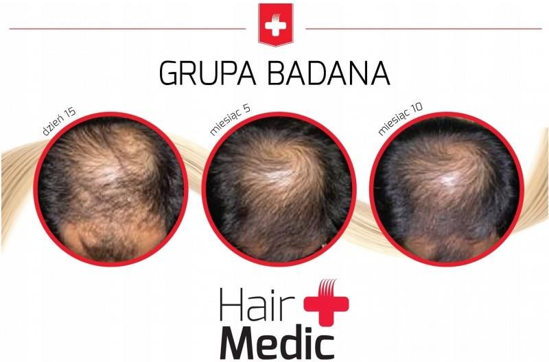 szampon hair medic rs opinie